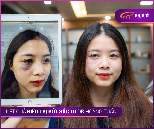 Kết quả điều trị bớt sắc tố tại Thẩm mỹ Hoàng Tuấn